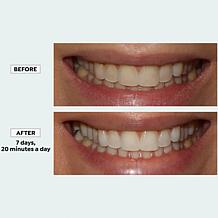 Intelliwhite Blue32 Whitening Kit