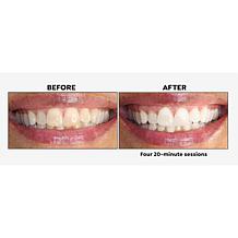 intelliWHiTE | Shop Teeth Whitening Kits, Toothpaste & Toothbrushes | HSN