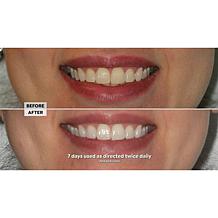 Intelliwhite Platinum Pen Whitening Kit with Turbo Boost