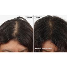 Keranique 120-Day Hair Regrowth Foam System with Scalp Massager