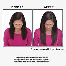 Keranique Hair Regrowth 60-Day Treatment w/ Scalp Massager Auto-Ship®