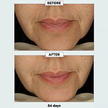 Metamorphosis Light Therapy LushLips Transformation Clinically Desi...