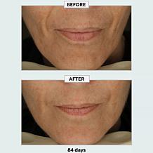 Metamorphosis Light Therapy LushLips Transformation LED Lip + Perio...