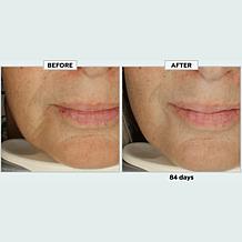 Metamorphosis Light Therapy LushLips Transformation LED Lip + Perio...