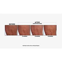 NassifMD® Crepe Inhibitor Triple Action Body Butter