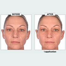 SKINN Non-Negotiables DermAppeal® Microdermabrasion Beauty Treatment