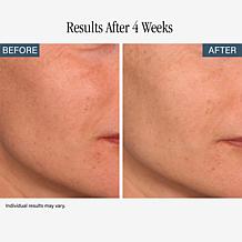 SKINN Non-Negotiables Multi-Acid Resurfacing Pads and Headband Duo