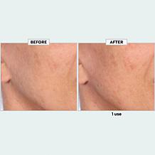TruRitl Dermaplane Set w Bag